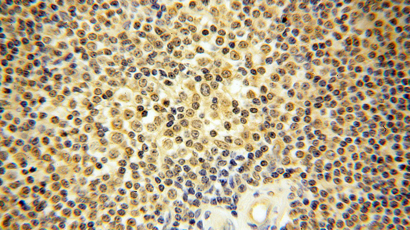 Immunohistochemical of paraffin-embedded human lymphoma using Catalog No:108879(CASP8 antibody) at dilution of 1:50 (under 40x lens)