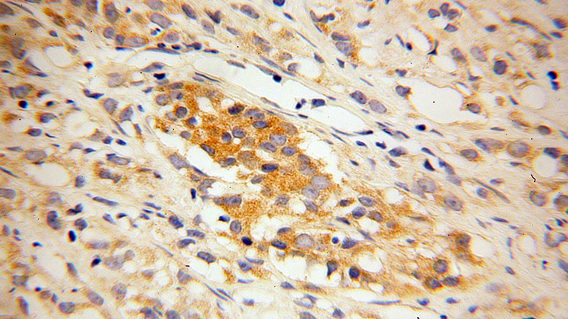 Immunohistochemical of paraffin-embedded human prostate cancer using Catalog No:112245(PPFIA1 antibody) at dilution of 1:100 (under 40x lens)