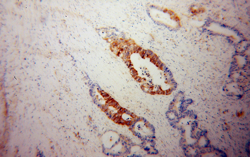 Immunohistochemical of paraffin-embedded human colon cancer using Catalog No:115845(TLN1 antibody) at dilution of 1:100 (under 10x lens)
