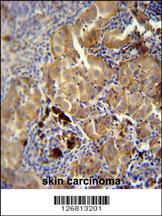 CD63 Antibody (C-term) (Cat. #169125) immunohistochemistry analysis in formalin fixed and paraffin embedded human skin carcinoma followed by peroxidase conjugation of the secondary antibody and DAB staining.  This data demonstrates the use of the CD63 Antibody (C-term) for immunohistochemistry.  Clinical relevance has not been evaluated.