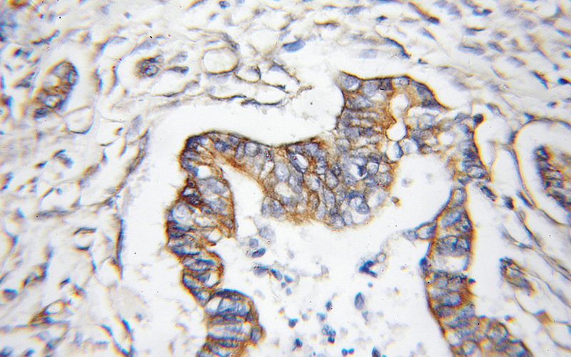 Immunohistochemical of paraffin-embedded human pancreas cancer using Catalog No:113336(OGT antibody) at dilution of 1:50 (under 10x lens)