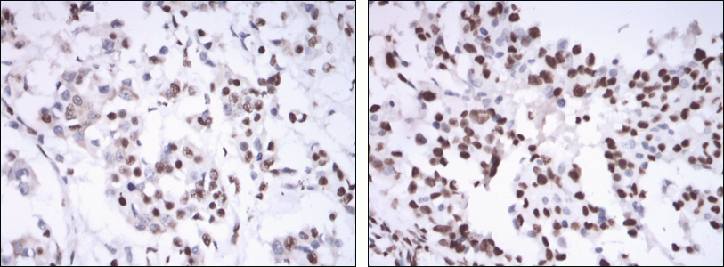 Immunohistochemical analysis of paraffin-embedded mammary cancer tissues using ESR1 mouse mAb with DAB staining.