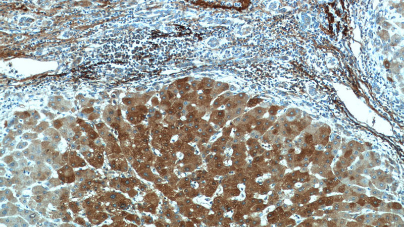 Immunohistochemistry of paraffin-embedded human hepatocirrhosis tissue slide using Catalog No:116760(VTN Antibody) at dilution of 1:50 (under 10x lens)