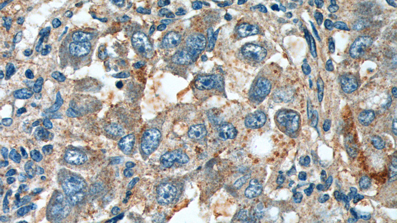 Immunohistochemistry of paraffin-embedded human liver cancer tissue slide using Catalog No:112293(Loc55908 Antibody) at dilution of 1:200 (under 40x lens).