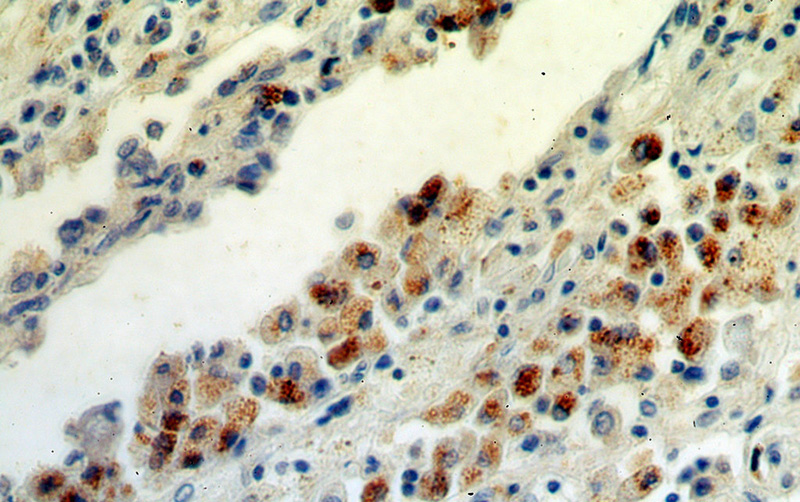 Immunohistochemical of paraffin-embedded human lung cancer using Catalog No:111937(ISG15 antibody) at dilution of 1:50 (under 40x lens)