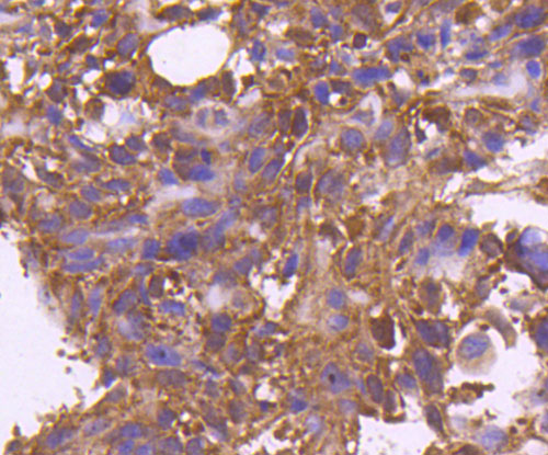 Fig4: Immunohistochemical analysis of paraffin-embedded human breast cancer tissue using anti-Osteoprotegerin antibody. Counter stained with hematoxylin.