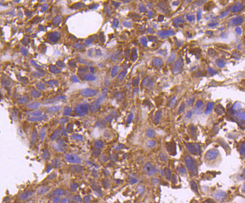 Fig4: Immunohistochemical analysis of paraffin-embedded human breast cancer tissue using anti-Osteoprotegerin antibody. Counter stained with hematoxylin.