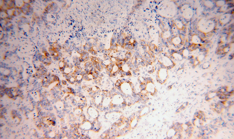 Immunohistochemical of paraffin-embedded human liver cancer using Catalog No:109472(COQ7 antibody) at dilution of 1:100 (under 10x lens)