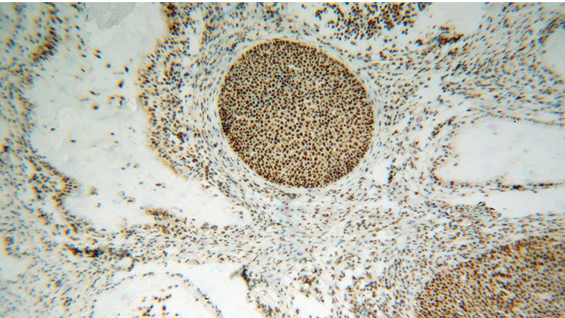 Immunohistochemical of paraffin-embedded human cervical cancer using Catalog No:113138(NF45 antibody) at dilution of 1:100 (under 10x lens)