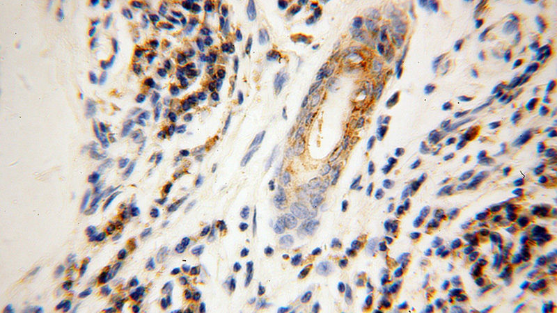 Immunohistochemical of paraffin-embedded human skin cancer using Catalog No:111015(GK3P antibody) at dilution of 1:100 (under 40x lens)