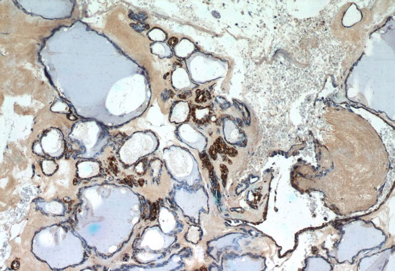 Immunohistochemistry of paraffin-embedded human thyroid tissue slide using Catalog No:108908(calreticulin Antibody) at dilution of 1:50 (under 10x lens)