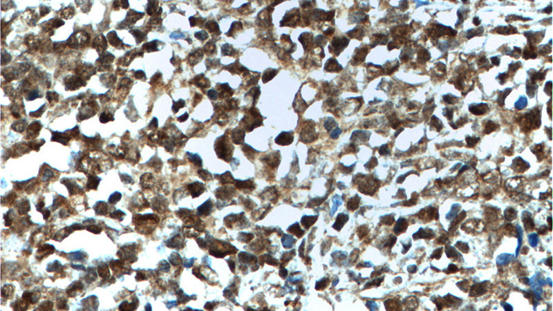 Immunohistochemistry of paraffin-embedded human lymphoma tissue slide using Catalog No:117102(BCL6 Antibody) at dilution of 1:400 (under 40x lens). heat mediated antigen retrieved with Sodium Citrate buffer (pH6).