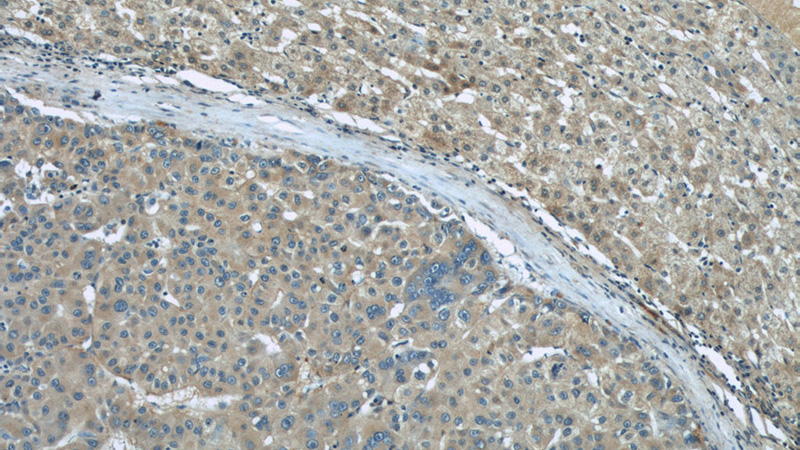 Immunohistochemical of paraffin-embedded human liver cancer using Catalog No:116022(BIGH3 antibody) at dilution of 1:50 (under 10x lens)