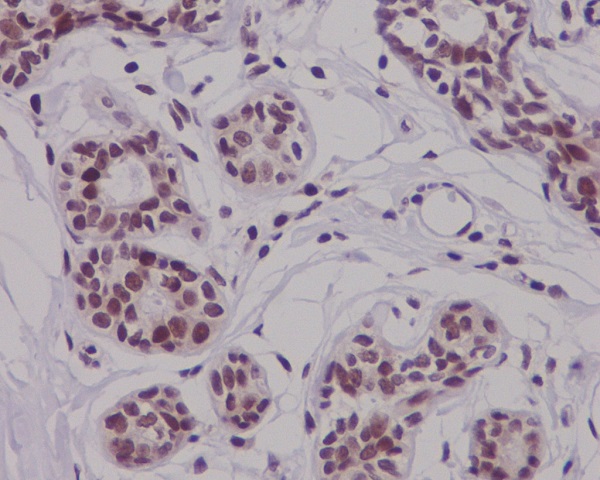 Immunohistochemical analysis of paraffin-embedded human breast carcinoma, using Phospho-Nrf2 (S40) Antibody.