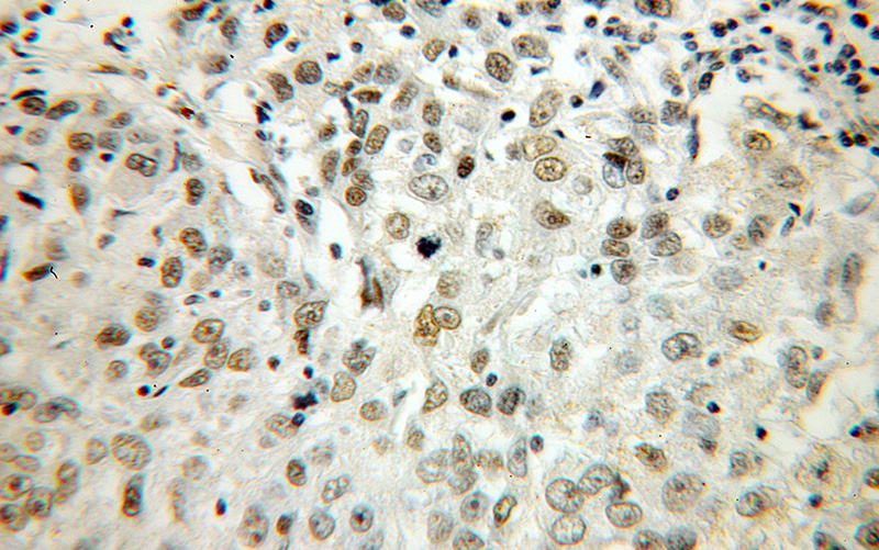 Immunohistochemical of paraffin-embedded human lung cancer using Catalog No:111468(HS1BP3 antibody) at dilution of 1:100 (under 40x lens)