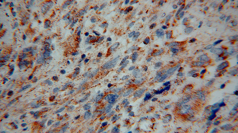 Immunohistochemical of paraffin-embedded human gliomas using Catalog No:113095(NEDD1 antibody) at dilution of 1:100 (under 40x lens)