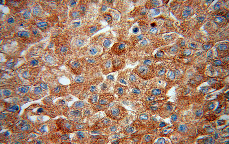 Immunohistochemical of paraffin-embedded human liver cancer using Catalog No:114095(PPP2CA antibody) at dilution of 1:50 (under 40x lens)