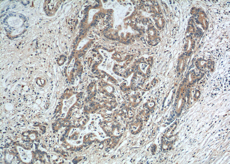 Immunohistochemistry of paraffin-embedded human pancreas cancer tissue slide using Catalog No:115173(SGSH Antibody) at dilution of 1:200 (under 10x lens).