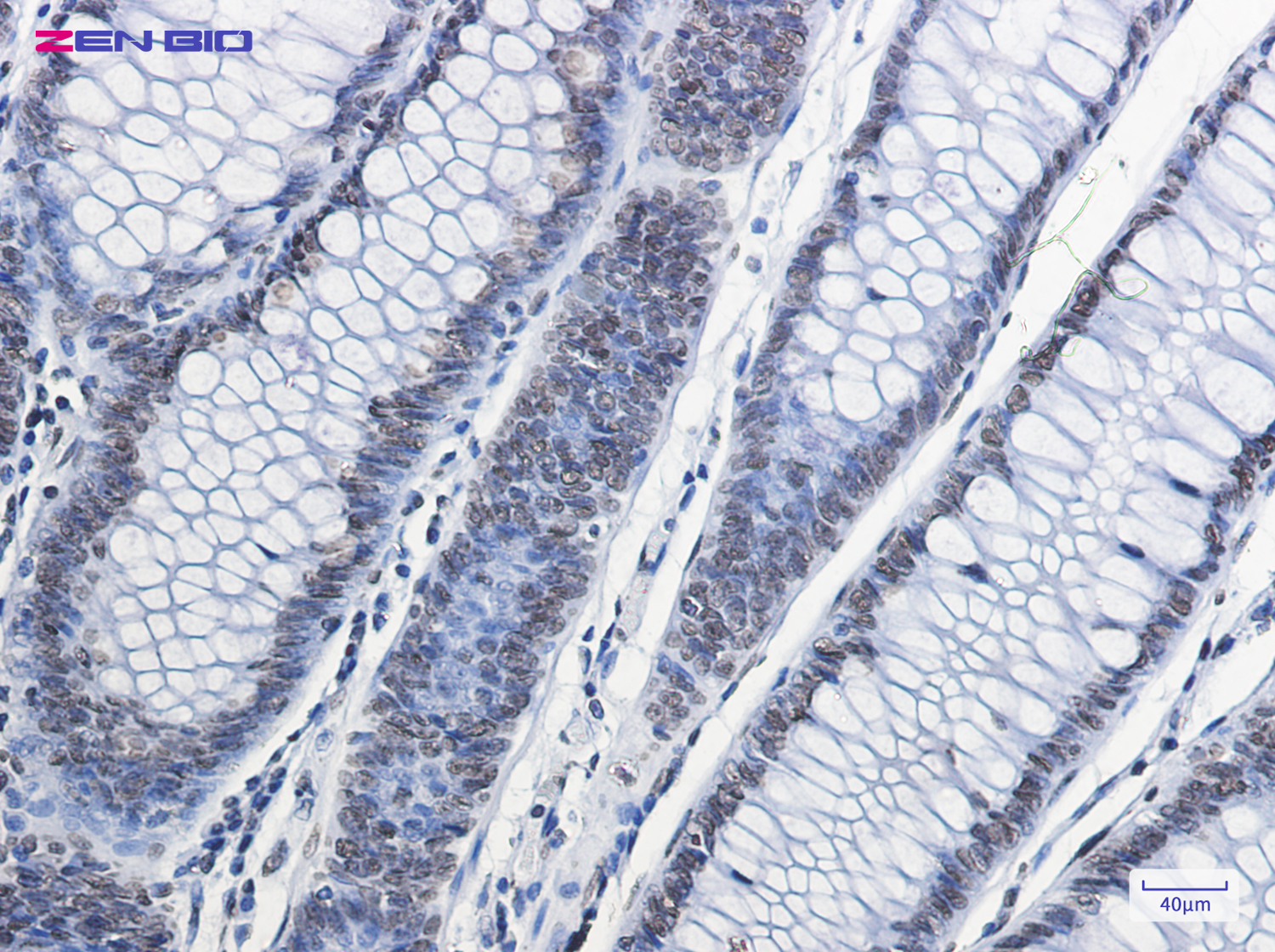 Immunohistochemistry of Histone H2A.X in paraffin-embedded Human colon cancer tissue using Histone H2A.X Rabbit pAb at dilution 1/50