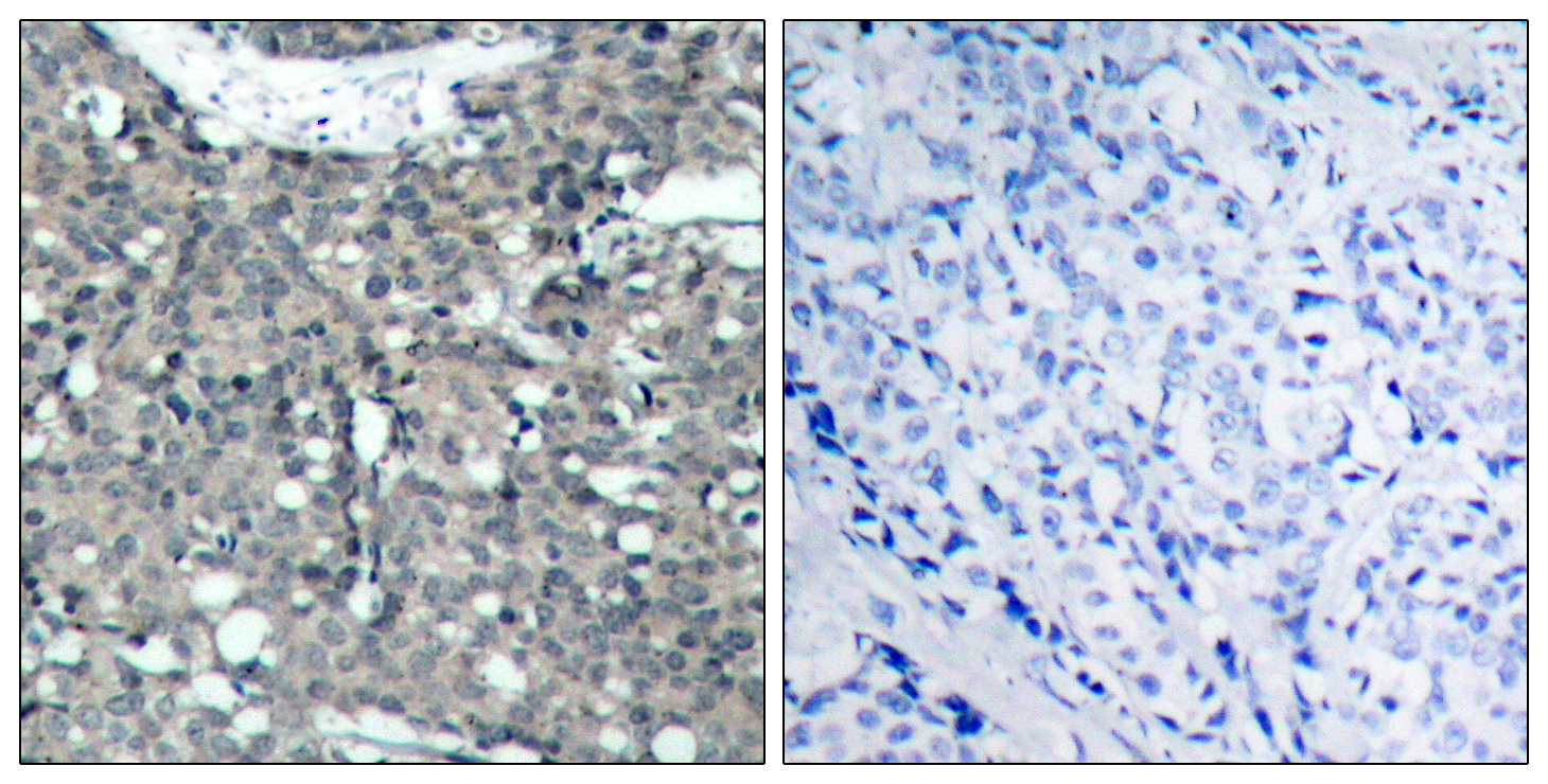Immunohistochemical analysis of paraffin-embedded human breast carcinoma tissue using Paxillin (Ab-118) Antibody  (left) or the same antibody preincubated with blocking peptide (right).