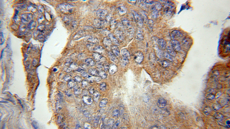 Immunohistochemical of paraffin-embedded human colon cancer using Catalog No:114002(POLG2 antibody) at dilution of 1:100 (under 10x lens)
