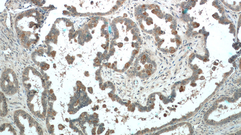 Immunohistochemistry of paraffin-embedded human ovary tumor tissue slide using Catalog No:113665(PDE6A Antibody) at dilution of 1:50 (under 10x lens)