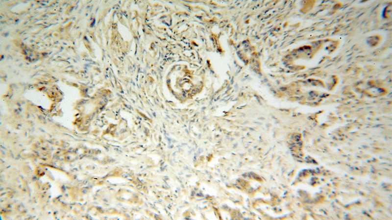 Immunohistochemical of paraffin-embedded human colon cancer using Catalog No:109916(DHDH antibody) at dilution of 1:100 (under 10x lens)