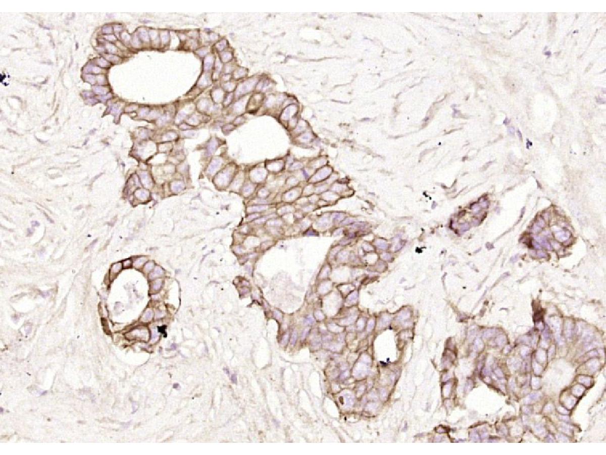 Fig3: Paraformaldehyde-fixed, paraffin embedded (human cervical carcinoma); Antigen retrieval by boiling in sodium citrate buffer (pH6.0) for 15min; Block endogenous peroxidase by 3% hydrogen peroxide for 20 minutes; Blocking buffer (normal goat serum) at 37℃ for 30min; Antibody incubation with (Pan Cytokeratin) Polyclonal Antibody, Unconjugated at 1:200 overnight at 4℃, followed by operating according to SP Kit(Rabbit) (sp-0023) instructionsand DAB staining.