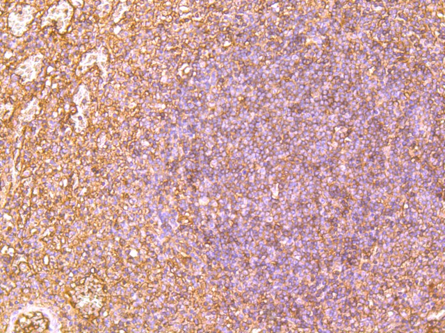 Fig3:; Immunohistochemical analysis of paraffin-embedded human spleen tissue using anti-Human IgM antibody. Counter stained with hematoxylin.