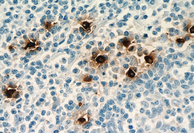 Immunohistochemistry of paraffin-embedded human tonsillitis tissue slide using (TPSAB1 Antibody) at dilution of 1:5000(under 40x lens). Heat mediated antigen retrieved with Citric acid buffer, pH6.0
