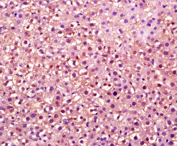 Fig1: Paraformaldehyde-fixed, paraffin embedded (rat liver tissue); Antigen retrieval by boiling in sodium citrate buffer (pH6.0) for 15min; Block endogenous peroxidase by 3% hydrogen peroxide for 20 minutes; Blocking buffer (normal goat serum) at 37℃ for 30min; Antibody incubation with (OVOL2) Polyclonal Antibody, Unconjugated at 1:400 overnight at 4℃, followed by a conjugated secondary (sp-0023) for 20 minutes and DAB staining.