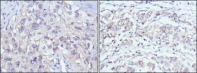 Immunohistochemical analysis of paraffin-embedded human lung cancer (left) and gastric cancer (right) using PAK2 mouse mAb with DAB staining.