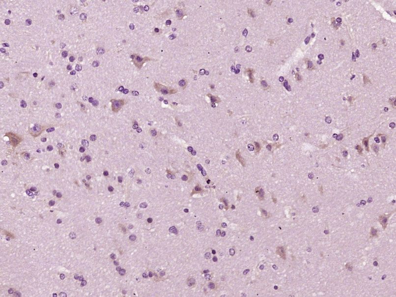 Fig2: Paraformaldehyde-fixed, paraffin embedded (Human brain glioma); Antigen retrieval by boiling in sodium citrate buffer (pH6.0) for 15min; Block endogenous peroxidase by 3% hydrogen peroxide for 20 minutes; Blocking buffer (normal goat serum) at 37℃ for 30min; Antibody incubation with (PCDH7) Polyclonal Antibody, Unconjugated at 1:400 overnight at 4℃, followed by operating according to SP Kit(Rabbit) (sp-0023) instructionsand DAB staining.