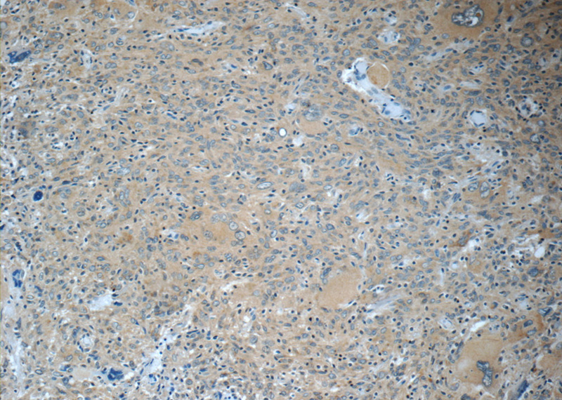Immunohistochemistry of paraffin-embedded human gliomas tissue slide using Catalog No:109238(CHN1 Antibody) at dilution of 1:50 (under 10x lens)