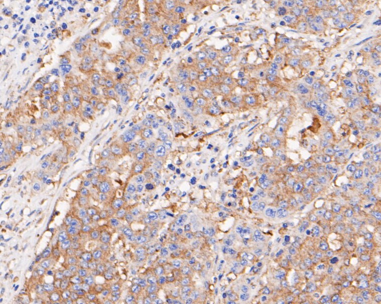 Fig5: Immunohistochemical analysis of paraffin-embedded human gastric carcinoma tissue using anti-BCL2L12 antibody. The section was pre-treated using heat mediated antigen retrieval with sodium citrate buffer (pH 6.0) for 20 minutes. The tissues were blocked in 5% BSA for 30 minutes at room temperature, washed with ddH2O and PBS, and then probed with the primary antibody ( 1/800) for 30 minutes at room temperature. The detection was performed using an HRP conjugated compact polymer system. DAB was used as the chromogen. Tissues were counterstained with hematoxylin and mounted with DPX.