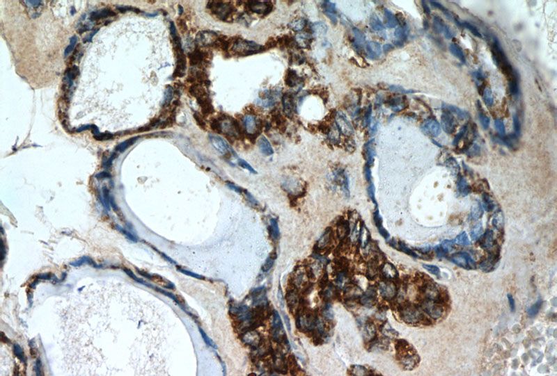 Immunohistochemistry of paraffin-embedded human thyroid tissue slide using Catalog No:108908(calreticulin Antibody) at dilution of 1:50 (under 40x lens)
