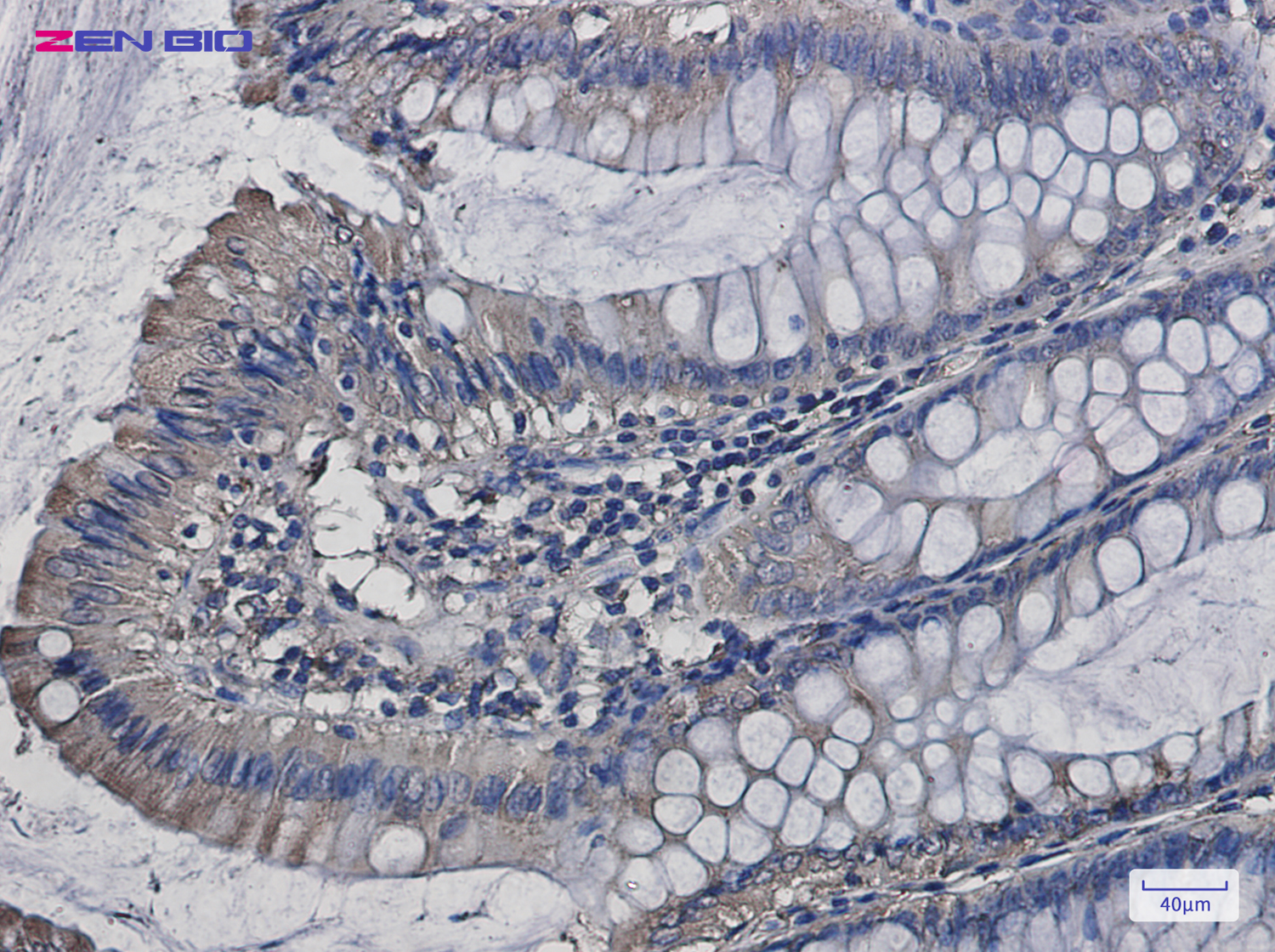 Immunohistochemistry of SERCA2 ATPase in paraffin-embedded Human colon cancer tissue using SERCA2 ATPase Rabbit pAb at dilution 1/50