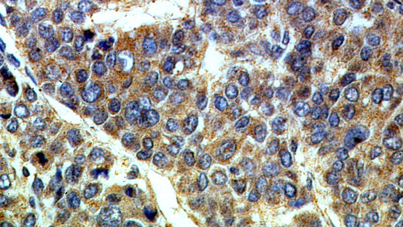 Immunohistochemical of paraffin-embedded human liver cancer using Catalog No:111068(GPNMB antibody) at dilution of 1:50 (under 40x lens)