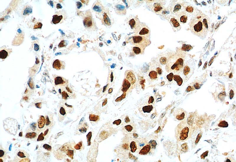 Immunohistochemical of paraffin-embedded human breast cancer using Catalog No:117335(PCNA antibody) at dilution of 1:800 (under 40x lens)