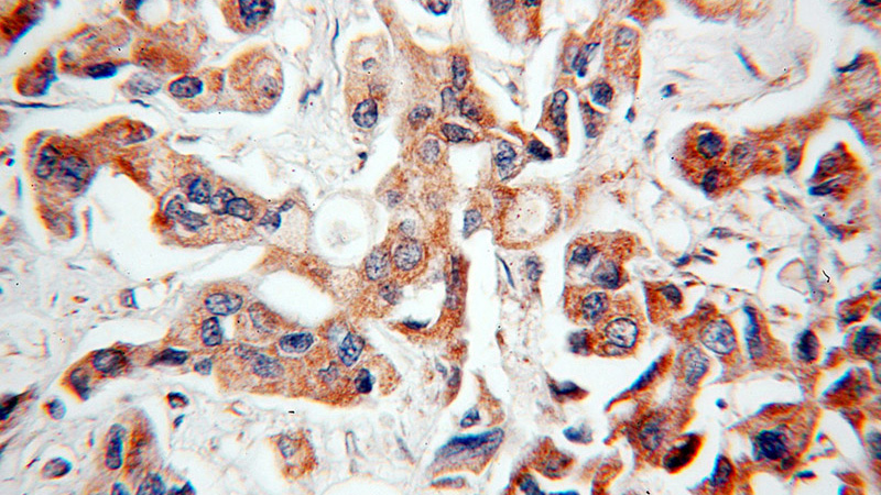 Immunohistochemical of paraffin-embedded human breast cancer using Catalog No:112959(NAT1 antibody) at dilution of 1:100 (under 40x lens)