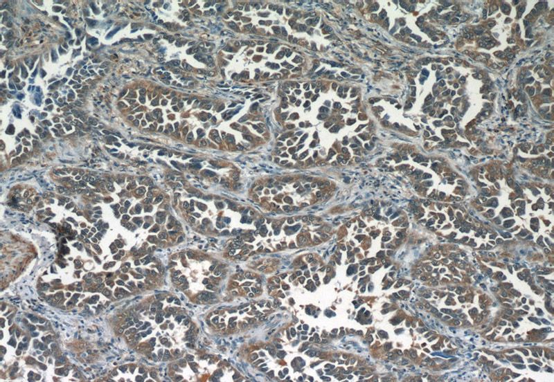 Immunohistochemistry of paraffin-embedded human lung cancer tissue slide using Catalog No:113042(NCOA3 Antibody) at dilution of 1:50