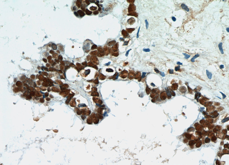Immunohistochemical of paraffin-embedded human ovary tumor using Catalog No:113609(PAX8 antibody) at dilution of 1:50 (under 40x lens)