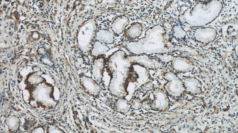 Immunohistochemical of paraffin-embedded human pancreas cancer using Catalog No:115123(SEPT9 antibody) at dilution of 1:50 (under 10x lens)