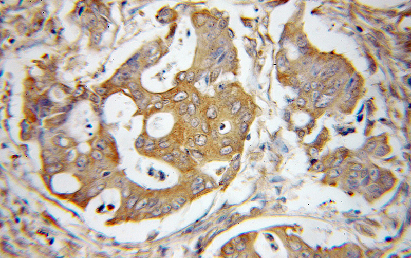 Immunohistochemical of paraffin-embedded human colon cancer using Catalog No:110187(EIF2S1 antibody) at dilution of 1:50 (under 10x lens)