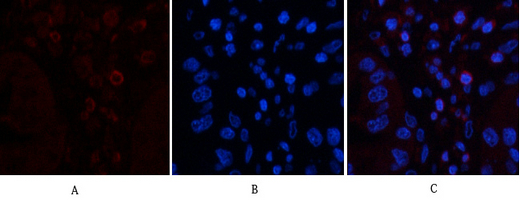 Immunofluorescence analysis of human-liver-cancer tissue. 1,CD45 Monoclonal Antibody(12A9)(red) was diluted at 1:200(4°C,overnight). 2, Cy3 labled Secondary antibody was diluted at 1:300(room temperature, 50min).3, Picture B: DAPI(blue) 10min. Picture A:Target. Picture B: DAPI. Picture C: merge of A+B