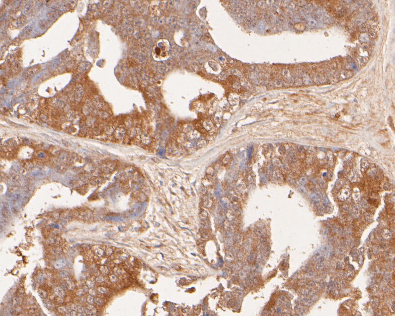 Fig3:; Immunohistochemical analysis of paraffin-embedded human prostate carcinoma tissue using anti-GADD34 antibody. The section was pre-treated using heat mediated antigen retrieval with Tris-EDTA buffer (pH 8.0-8.4) for 20 minutes.The tissues were blocked in 5% BSA for 30 minutes at room temperature, washed with ddH; 2; O and PBS, and then probed with the primary antibody ( 1/50) for 30 minutes at room temperature. The detection was performed using an HRP conjugated compact polymer system. DAB was used as the chromogen. Tissues were counterstained with hematoxylin and mounted with DPX.