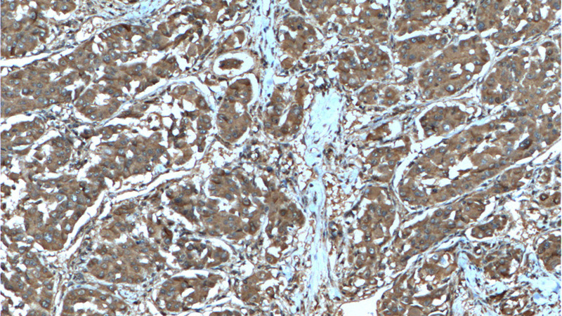 Immunohistochemistry of paraffin-embedded human liver cancer tissue slide using Catalog No:107586(SGTA Antibody) at dilution of 1:200 (under 10x lens).